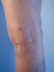 Varicose Veins in leg before treatment at Vein Care Specialists in Lakeland, FL