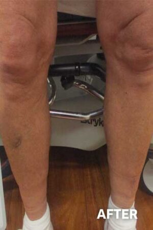 Sclerotherapy After 1