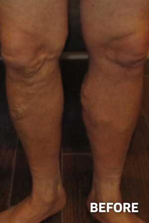 Sclerotherapy Before 1