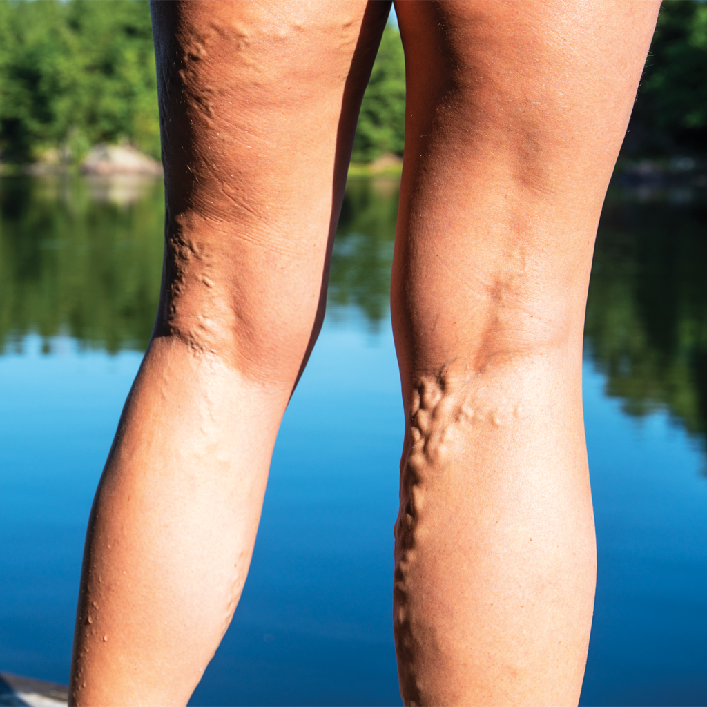 What Are Varicose Veins?